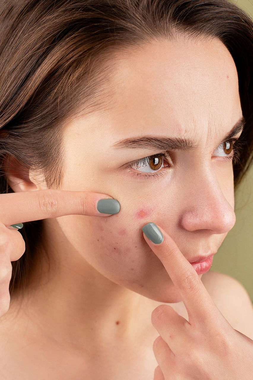 Acne Prone Skin Solved: Your Step-by-Step Guide to Clear, Healthy Skin